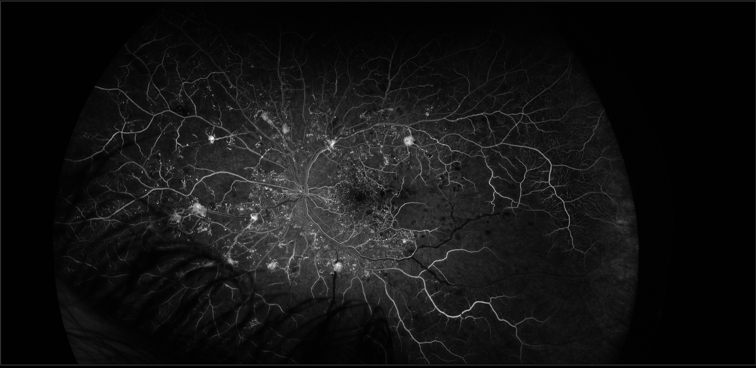 Widefield Fluorescein Angiogram of Diabetic Retina.